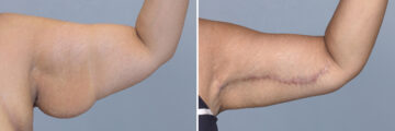 Body Procedures before and after photos in FL, Palm Beach Gardens, Patient 1116