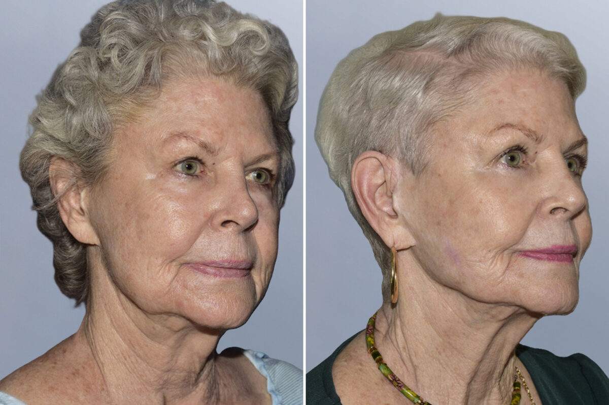 Face Procedures before and after photos in FL, Palm Beach Gardens, Patient 1121