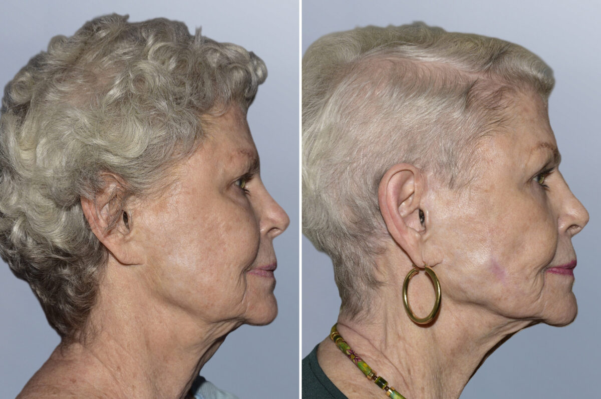 Face Procedures before and after photos in FL, Palm Beach Gardens, Patient 1121