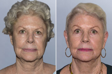 Face Procedures before and after photos in FL, Palm Beach Gardens, Patient 1121