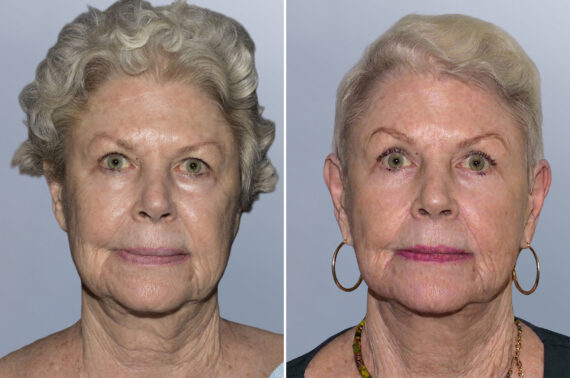 Face Procedures before and after photos in FL, Palm Beach Gardens, Patient 1121