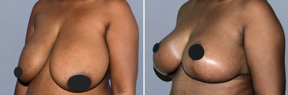 Breast Lift (Mastopexy) before and after photos in FL, Palm Beach Gardens, Patient 1128