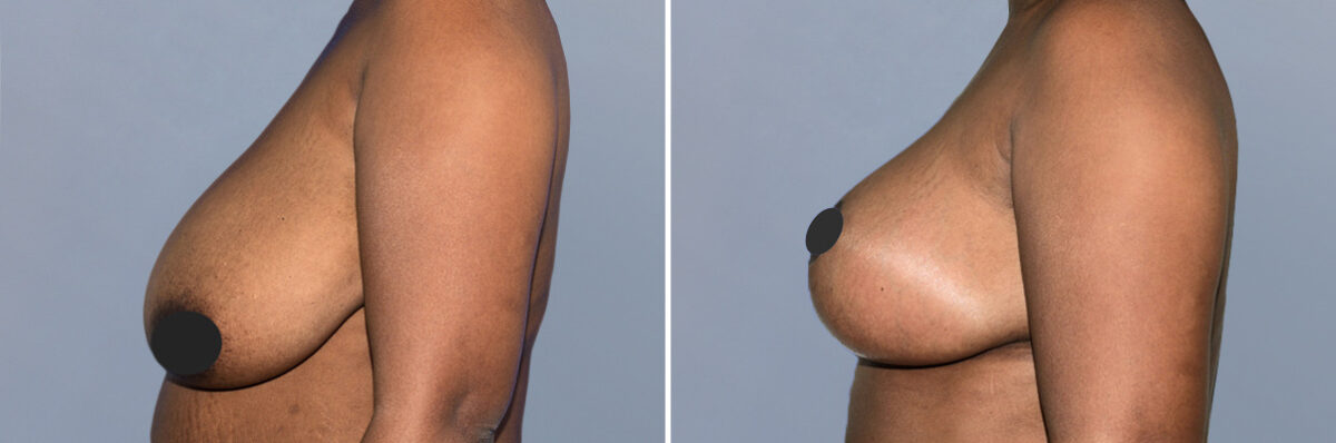 Breast Lift (Mastopexy) before and after photos in FL, Palm Beach Gardens, Patient 1128
