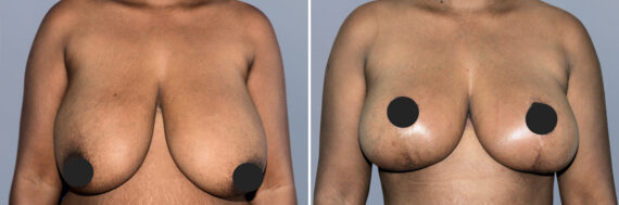 Breast Lift (Mastopexy) before and after photos in FL, Palm Beach Gardens, Patient 1128