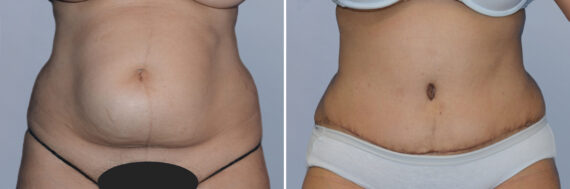 Body Procedures before and after photos in FL, Palm Beach Gardens