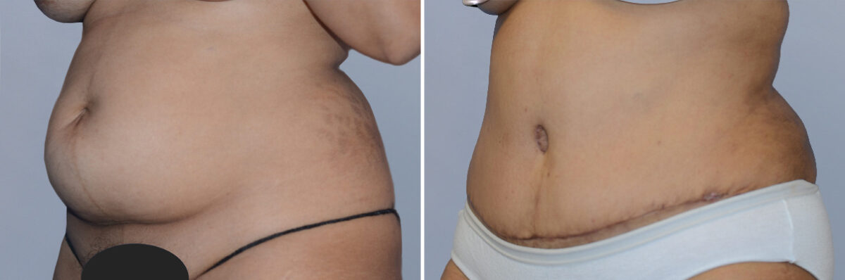 Body Procedures before and after photos in FL, Palm Beach Gardens, Patient 1135