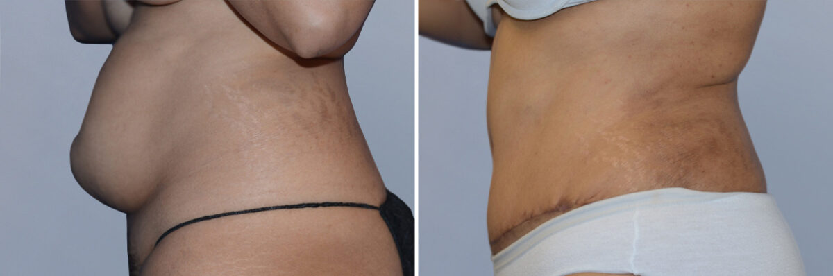 Body Procedures before and after photos in FL, Palm Beach Gardens, Patient 1135