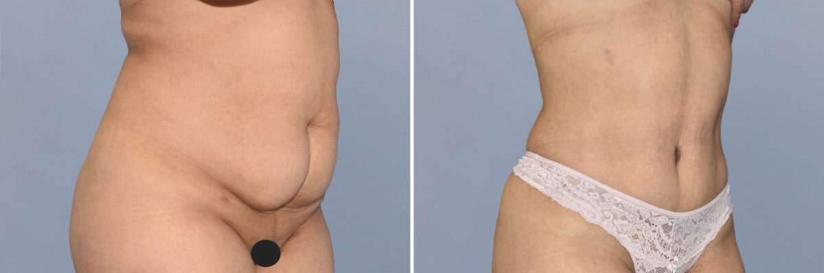 Body Procedures before and after photos in FL, Palm Beach Gardens, Patient 1142