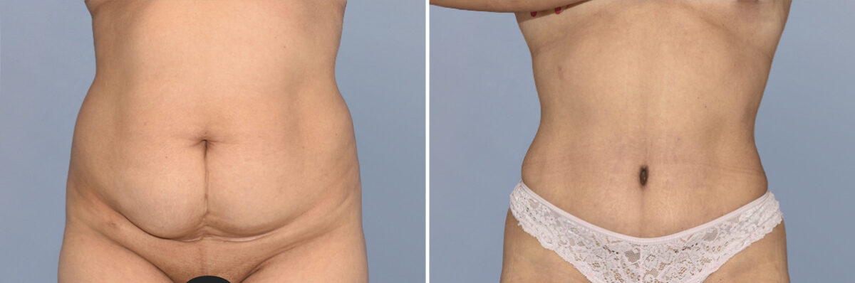 Body Procedures before and after photos in FL, Palm Beach Gardens, Patient 1142