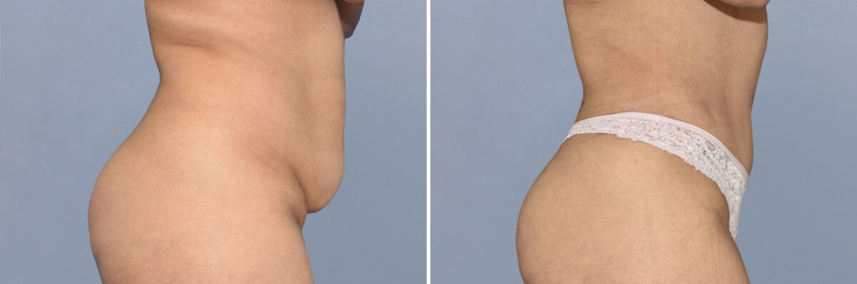 Body Procedures before and after photos in FL, Palm Beach Gardens, Patient 1142