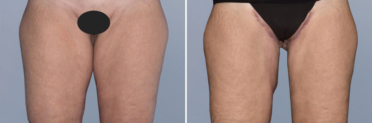 Body Procedures before and after photos in FL, Palm Beach Gardens, Patient 1149