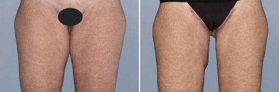 Body Procedures before and after photos in FL, Palm Beach Gardens, Patient 1149