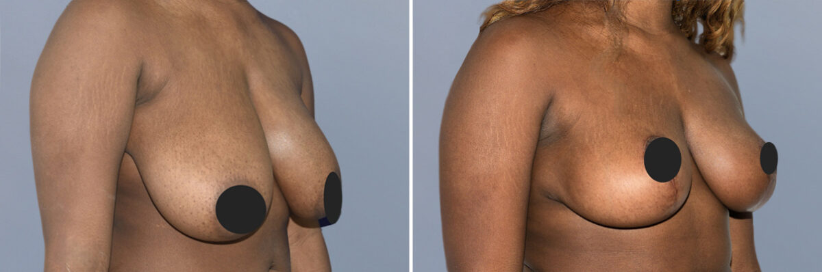 Breast Procedures before and after photos in FL, Palm Beach Gardens, Patient 1152