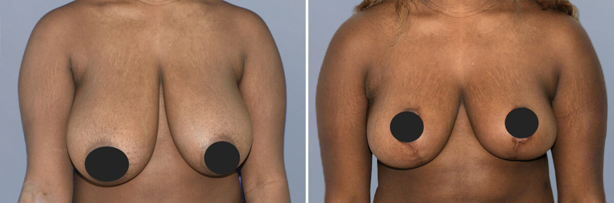 Breast Procedures before and after photos in FL, Palm Beach Gardens, Patient 1152