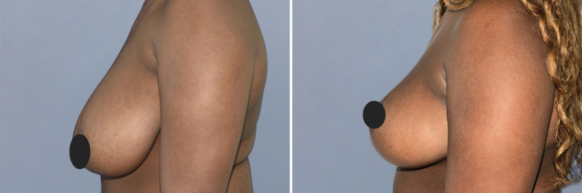 Breast Procedures before and after photos in FL, Palm Beach Gardens, Patient 1152