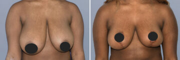 Breast Procedures before and after photos in FL, Palm Beach Gardens, Patient 1152