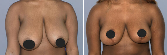Breast Procedures before and after photos in FL, Palm Beach Gardens, Patient 1152