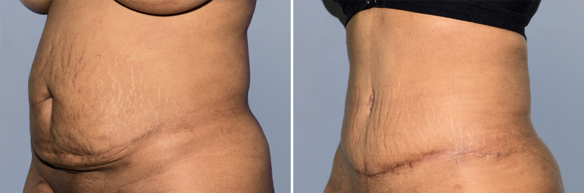 Body Procedures before and after photos in FL, Palm Beach Gardens, Patient 1159
