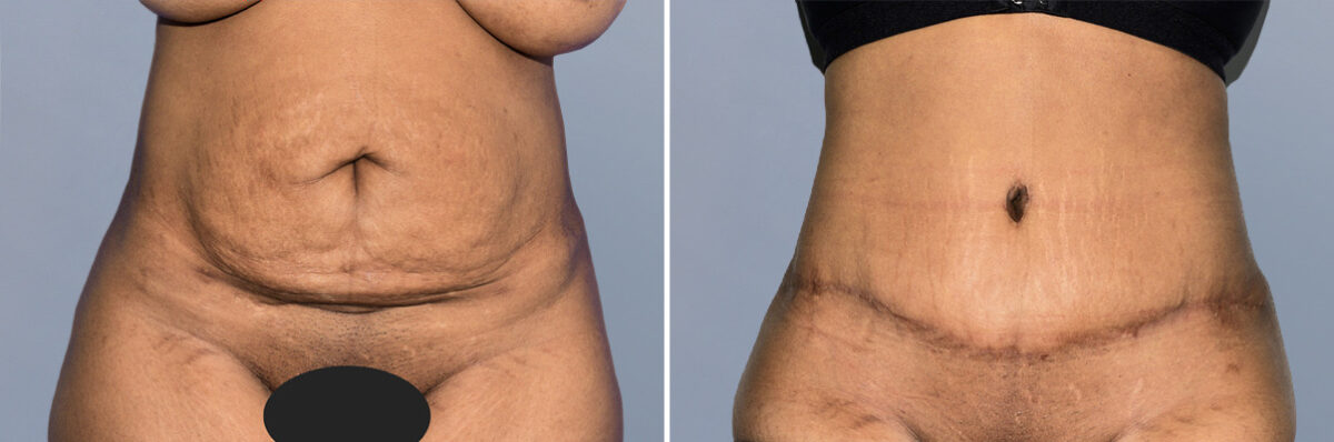 Body Procedures before and after photos in FL, Palm Beach Gardens, Patient 1159