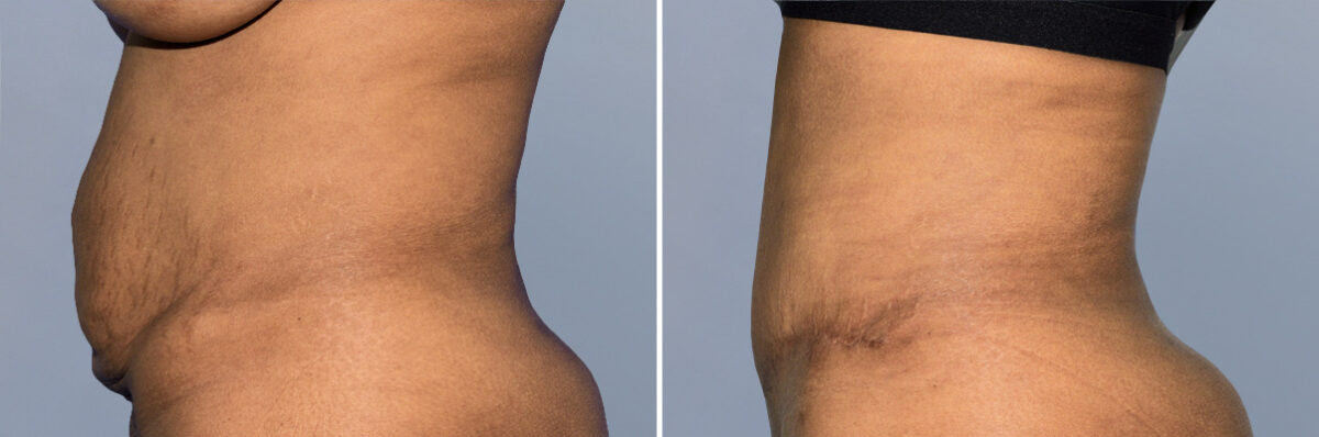 Body Procedures before and after photos in FL, Palm Beach Gardens, Patient 1159