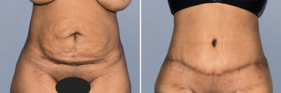 Body Procedures before and after photos in FL, Palm Beach Gardens, Patient 1159