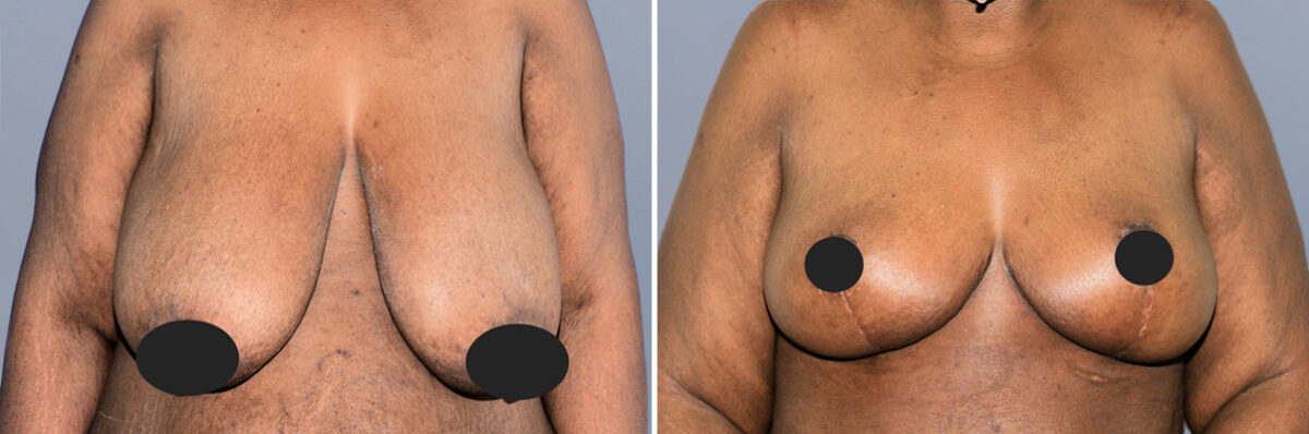 Breast Procedures before and after photos in FL, Palm Beach Gardens, Patient 1166