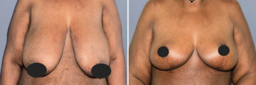 Breast Procedures before and after photos in FL, Palm Beach Gardens, Patient 1166