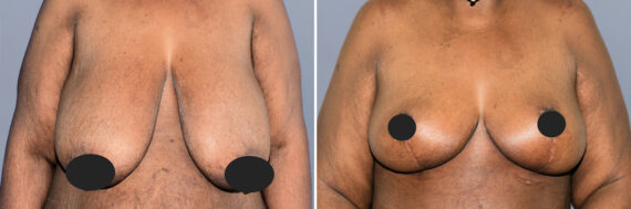 Breast Procedures before and after photos in FL, Palm Beach Gardens, Patient 1166