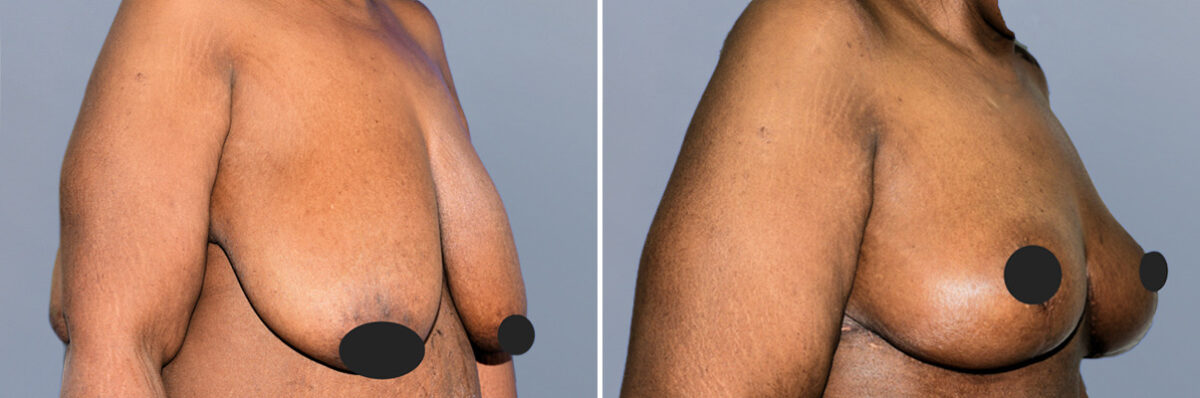 Breast Procedures before and after photos in FL, Palm Beach Gardens, Patient 1166