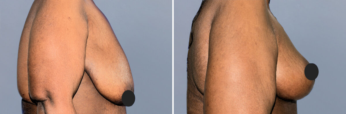 Breast Procedures before and after photos in FL, Palm Beach Gardens, Patient 1166