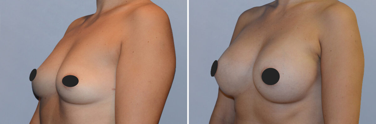 Breast Augmentation before and after photos in FL, Palm Beach Gardens, Patient 1173