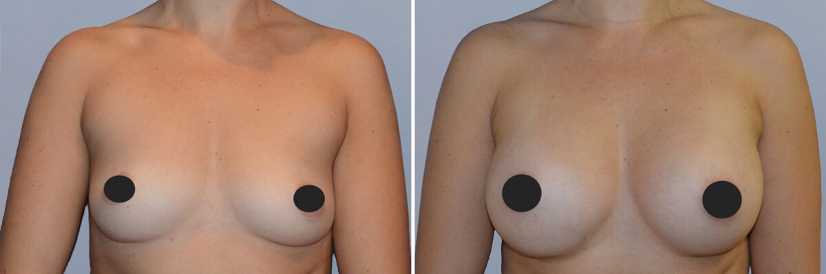 Breast Augmentation before and after photos in FL, Palm Beach Gardens, Patient 1173