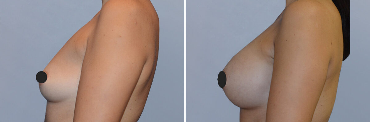 Breast Augmentation before and after photos in FL, Palm Beach Gardens, Patient 1173