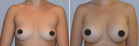 Breast Augmentation before and after photos in FL, Palm Beach Gardens, Patient 1173
