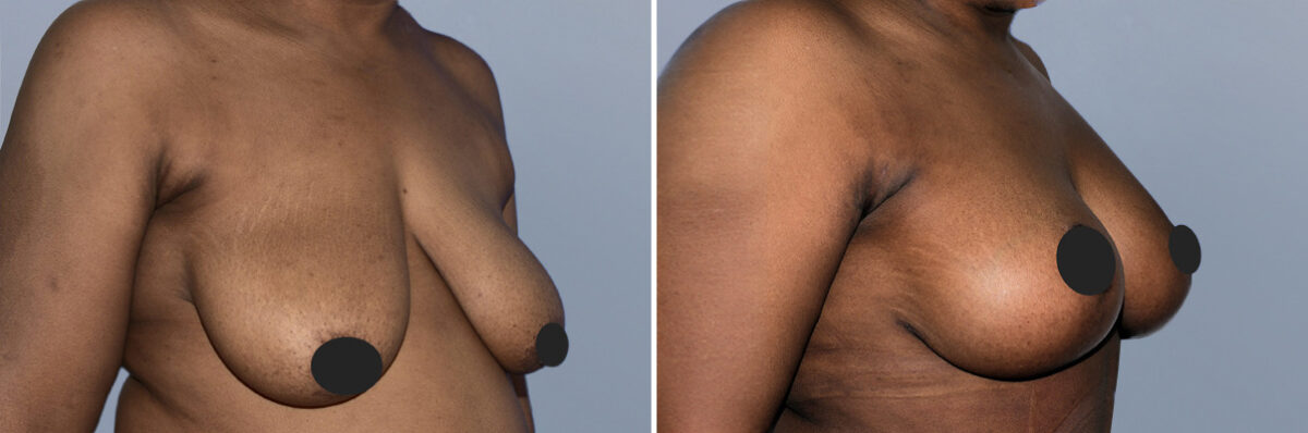 Breast Augmentation and Lift before and after photos in FL, Palm Beach Gardens, Patient 1180