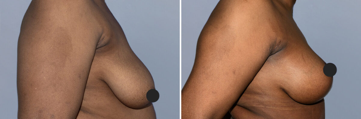 Breast Augmentation and Lift before and after photos in FL, Palm Beach Gardens, Patient 1180