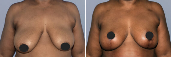Breast Augmentation and Lift before and after photos in FL, Palm Beach Gardens, Patient 1180