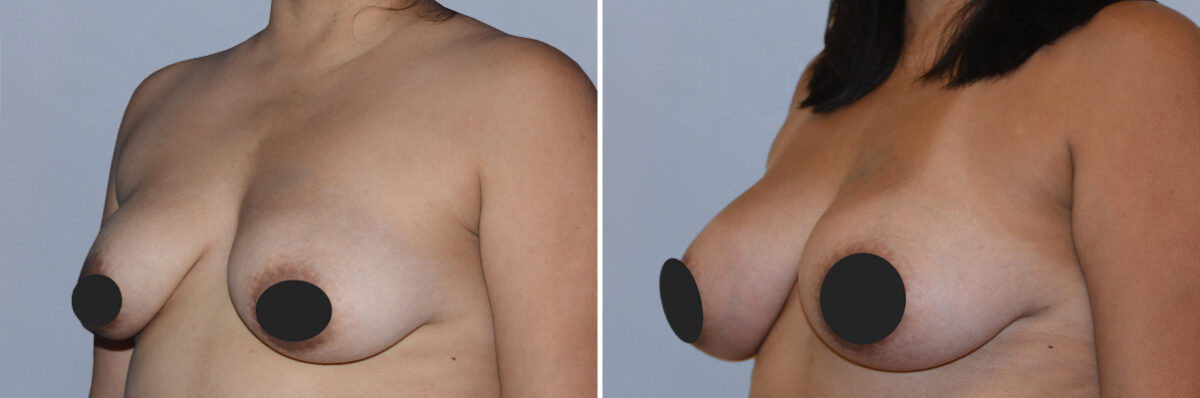 Breast Fat Transfer before and after photos in FL, Palm Beach Gardens, Patient 1187