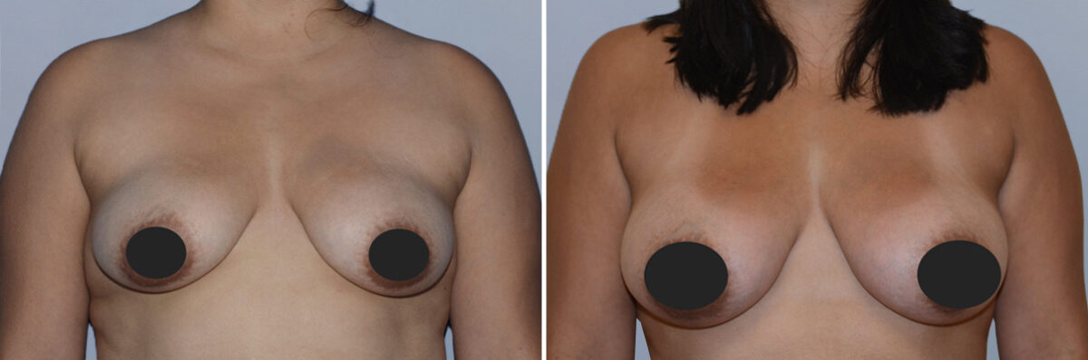 Breast Fat Transfer before and after photos in FL, Palm Beach Gardens, Patient 1187
