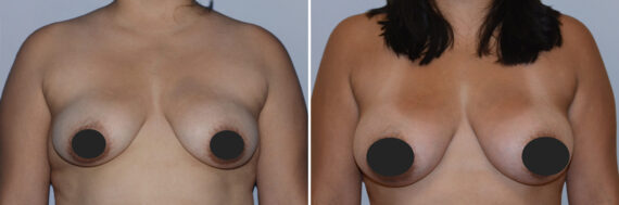 Breast Fat Transfer before and after photos in FL, Palm Beach Gardens, Patient 1187