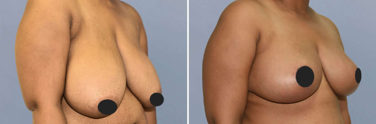 Breast Procedures before and after photos in FL, Palm Beach Gardens, Patient 1192