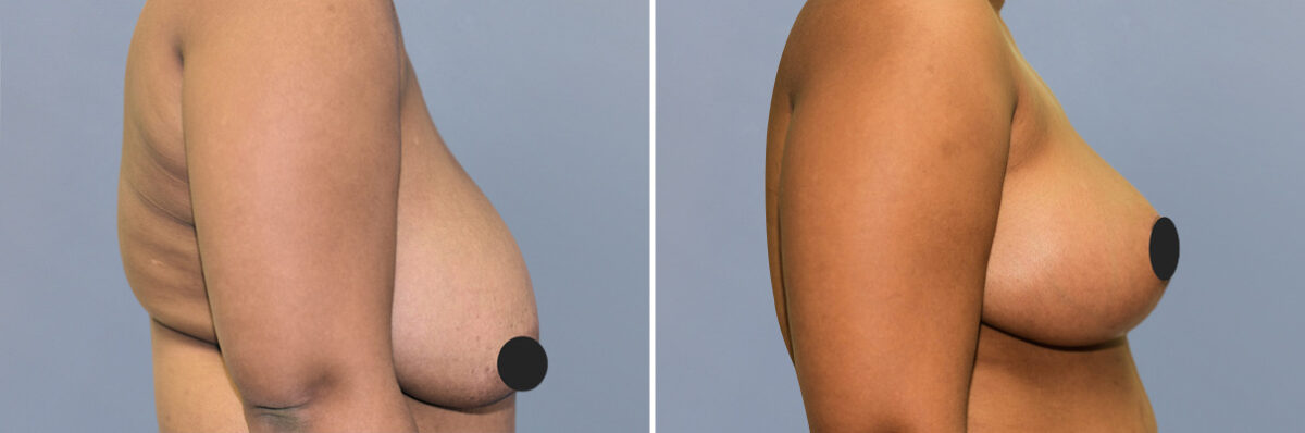 Breast Procedures before and after photos in FL, Palm Beach Gardens, Patient 1192