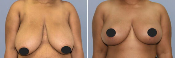 Breast Procedures before and after photos in FL, Palm Beach Gardens, Patient 1192