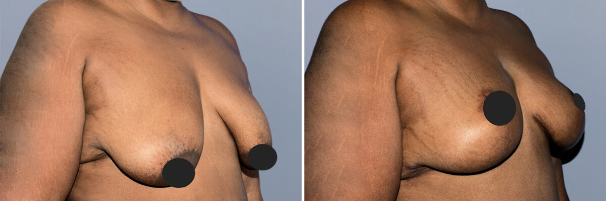 Breast Lift (Mastopexy) before and after photos in FL, Palm Beach Gardens, Patient 1199