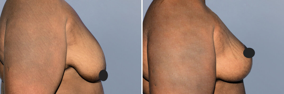 Breast Lift (Mastopexy) before and after photos in FL, Palm Beach Gardens, Patient 1199