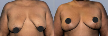 Breast Lift (Mastopexy) before and after photos in FL, Palm Beach Gardens, Patient 1199