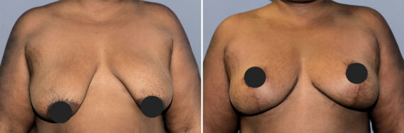 Breast Lift (Mastopexy) before and after photos in FL, Palm Beach Gardens, Patient 1199