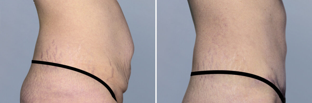 Body Procedures before and after photos in FL, Palm Beach Gardens, Patient 1206