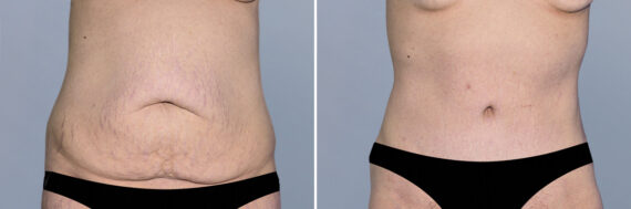 Body Procedures before and after photos in FL, Palm Beach Gardens, Patient 1206