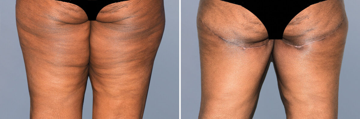 Body Procedures before and after photos in FL, Palm Beach Gardens, Patient 1211